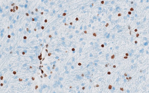 4D1 Diffuse midline glioma, (Case 4) H3K27me3 3