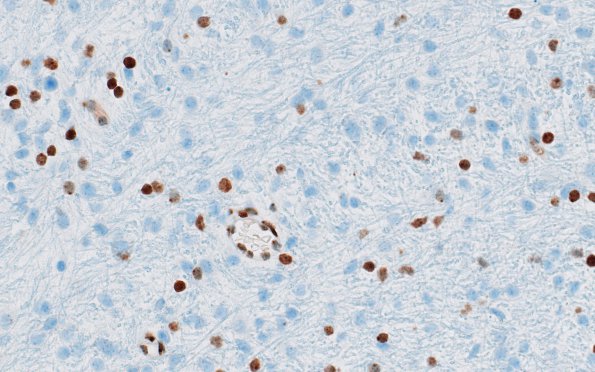 4D2 Diffuse midline glioma, (Case 4) H3K27me3 4
