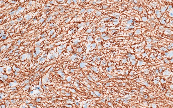 4G Diffuse midline glioma, (Case 4) NF 1