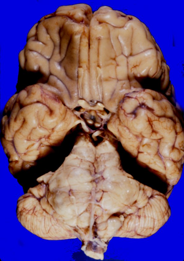 5A1 Glioblastoma, pons, child (Case 5) 1