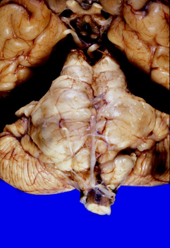 5A2 Glioblastoma, pons, child (Case 5) 3