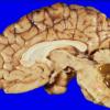 5A3 Glioblastoma (Case 5) 3 brainstem