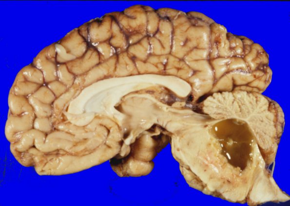 5A3 Glioblastoma (Case 5) 3 brainstem