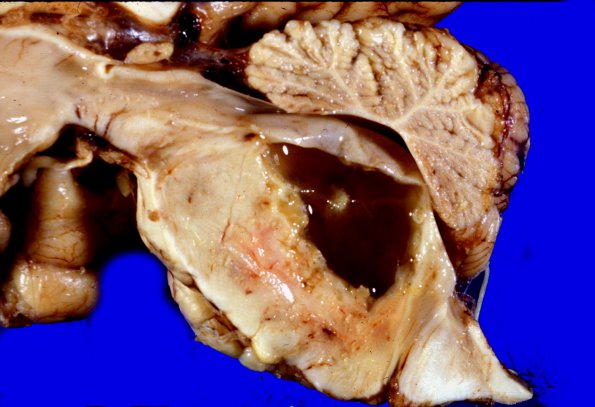 5A4 Glioblastoma, pons, child (Case 5) 5