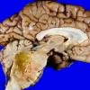 5A5 Glioblastoma, pons, child (Case 5) 4