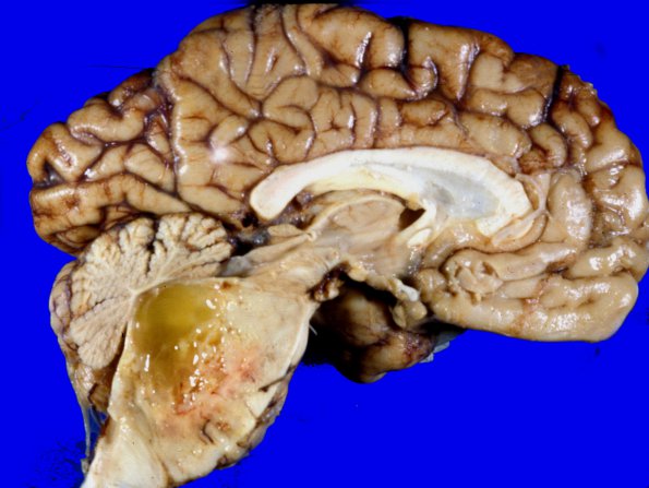 5A5 Glioblastoma, pons, child (Case 5) 4