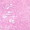 5B1 Glioblastoma, pons, child (Case 5) H&E 10X