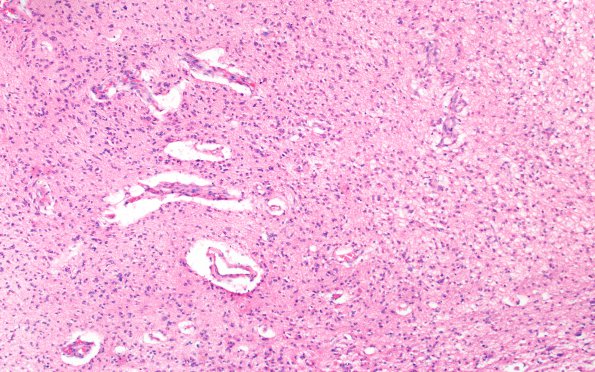 5B1 Glioblastoma, pons, child (Case 5) H&E 10X