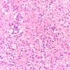 5B2 Glioblastoma, pons, child (Case 5) H&E 20X