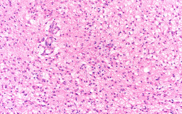 5B2 Glioblastoma, pons, child (Case 5) H&E 20X