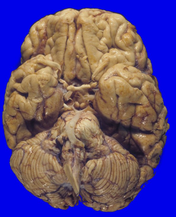 6A1 GBM, thalamus (Case 6) 4