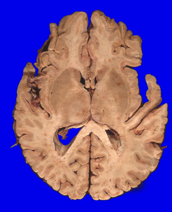 6A2 GBM (Case 6) 6