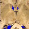 6A3 GBM, thalamus (Case 6) 5