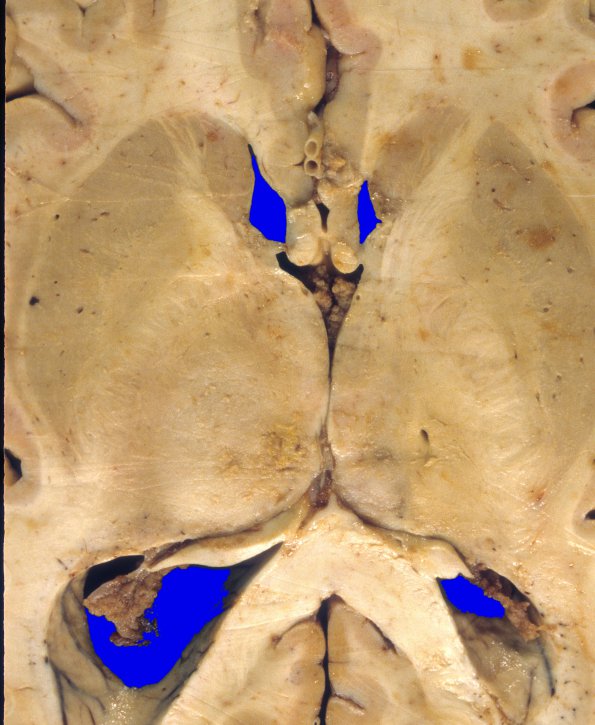 6A3 GBM, thalamus (Case 6) 5