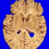 6A4 GBM, thalamus (Case 6) 1