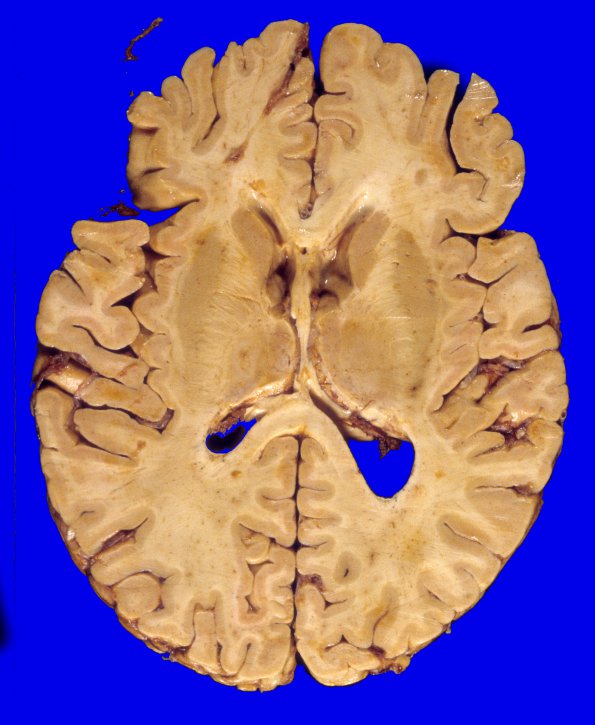 6A4 GBM, thalamus (Case 6) 1