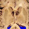 6A5 GBM, thalamus (Case 6) 2