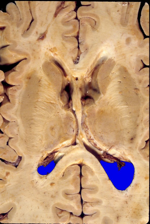 6A5 GBM, thalamus (Case 6) 2