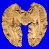 6A6 GBM, thalamus (Case 6)  7