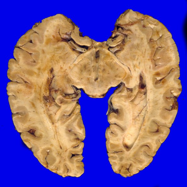 6A6 GBM, thalamus (Case 6)  7