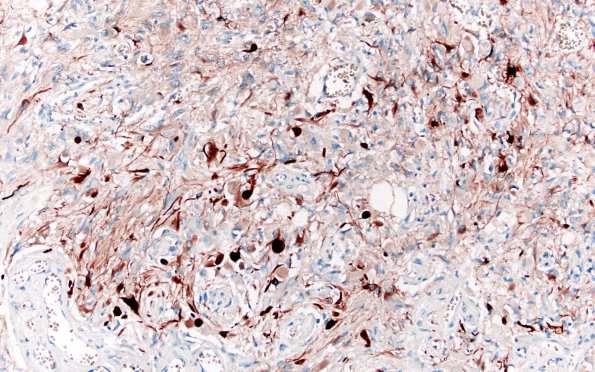 6B GBM, thalamus (Case 6) H3K27M 20X