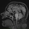 7A1 Anaplastic astrocytoma (DIPG mimic, Case 7) T2 FLAIR