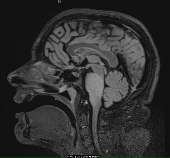 7A1 Anaplastic astrocytoma (DIPG mimic, Case 7) T2 FLAIR