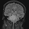 7A2 Anaplastic astrocytoma (DIPG mimic, Case 7) T2 FLAIR 2