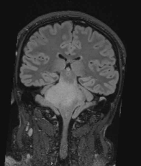 7A2 Anaplastic astrocytoma (DIPG mimic, Case 7) T2 FLAIR 2