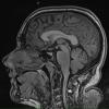 7A3 Anaplastic astrocytoma (DIPG mimic, Case 7) T1 noC