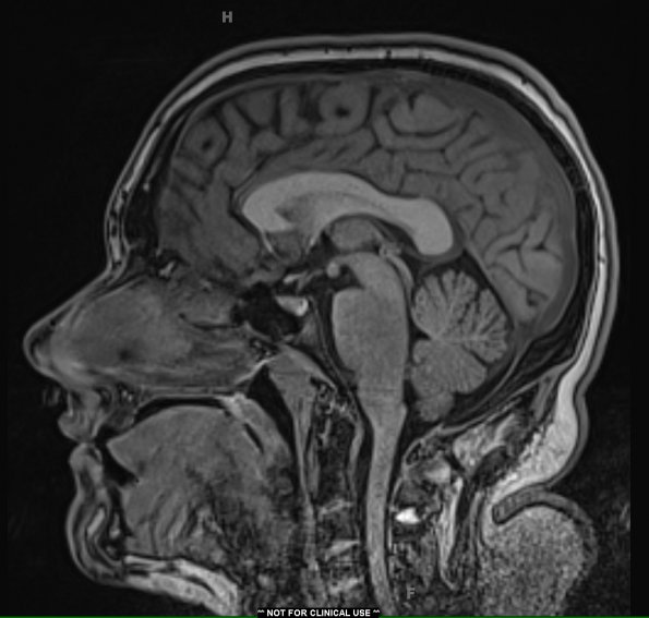 7A3 Anaplastic astrocytoma (DIPG mimic, Case 7) T1 noC