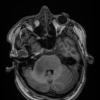 7A4 Anaplastic astrocytoma (DIPG mimic, Case 7) T1 noC 2