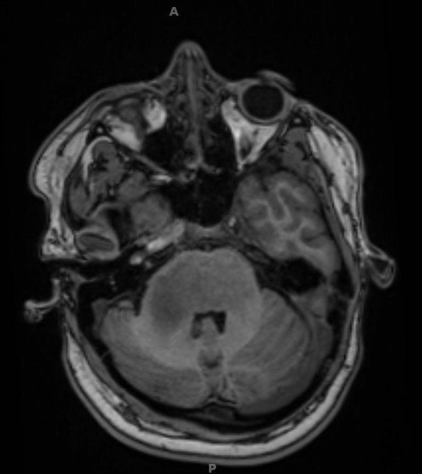 7A4 Anaplastic astrocytoma (DIPG mimic, Case 7) T1 noC 2