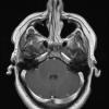 7A5 Anaplastic astrocytoma (DIPG mimic, Case 7) T1W 1