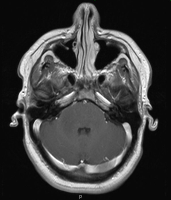 7A5 Anaplastic astrocytoma (DIPG mimic, Case 7) T1W 1