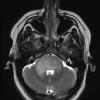 7A6 Anaplastic astrocytoma (DIPG mimic, Case 7) T2W