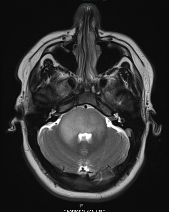 7A6 Anaplastic astrocytoma (DIPG mimic, Case 7) T2W