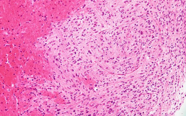 7B1 Astrocytoma, anaplastic (not DIPG, Case 7) H&E 3