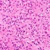 7B2 Astrocytoma, anaplastic (not DIPG, Case 7) H&E 6