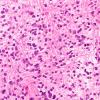 7B3 Astrocytoma, anaplastic (not DIPG, Case 7) H&E 4