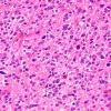 7B4 Astrocytoma, anaplastic (not DIPG, Case 7) H&E 10