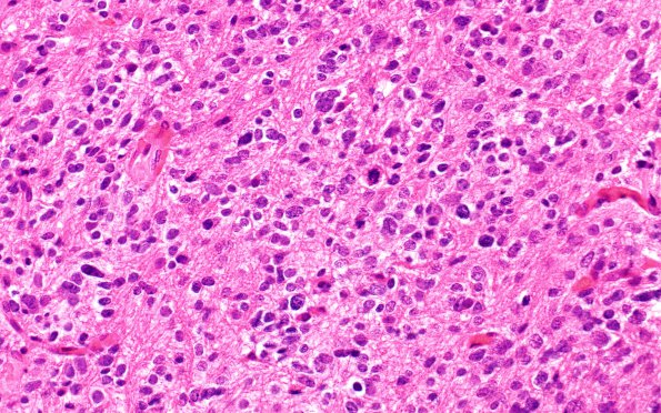 7B4 Astrocytoma, anaplastic (not DIPG, Case 7) H&E 10