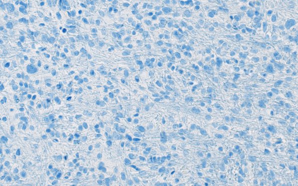 7C1 Astrocytoma, anaplastic (not DIPG, Case 7) H3 K27M 1