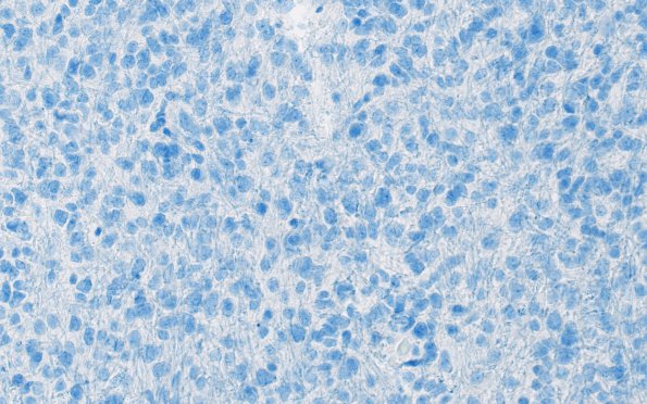 7C2 Astrocytoma, anaplastic (not DIPG, Case 7) H3 K27M 3