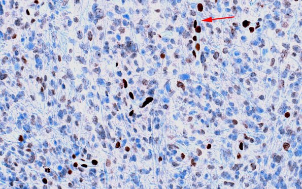 7D Astrocytoma, anaplastic (not DIPG, Case 7) H3 K27me3 2 copy