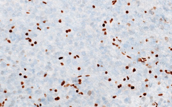 7G2 Astrocytoma, anaplastic (not DIPG, Case 7) ATRX 5