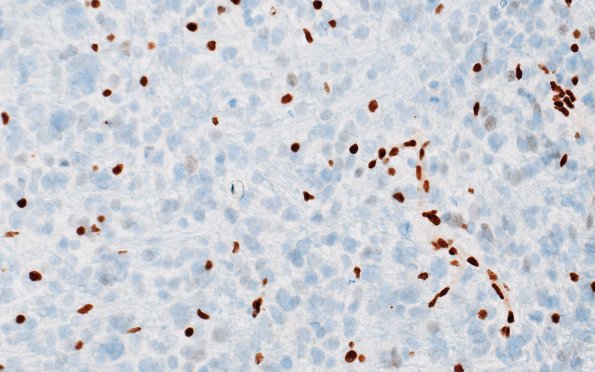 7G3 Astrocytoma, anaplastic (not DIPG, Case 7) ATRX 3