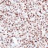 7H1 Astrocytoma, anaplastic (not DIPG, Case 7) p53 4