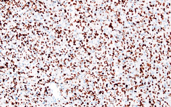 7H1 Astrocytoma, anaplastic (not DIPG, Case 7) p53 4