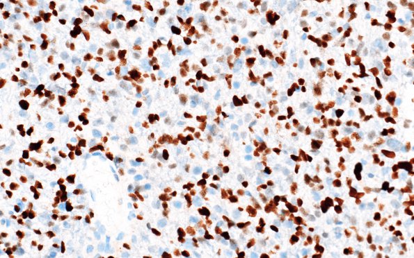 7H2 Astrocytoma, anaplastic (not DIPG, Case 7) p53 3